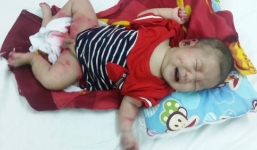 Xót xa bé trai 3 tháng tuổi bị lở loét gần hết cơ thể